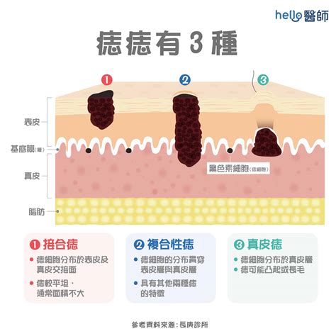 臉部 痣|痣形成的原因？痣長毛、痣變多變大是痣病變？5招判。